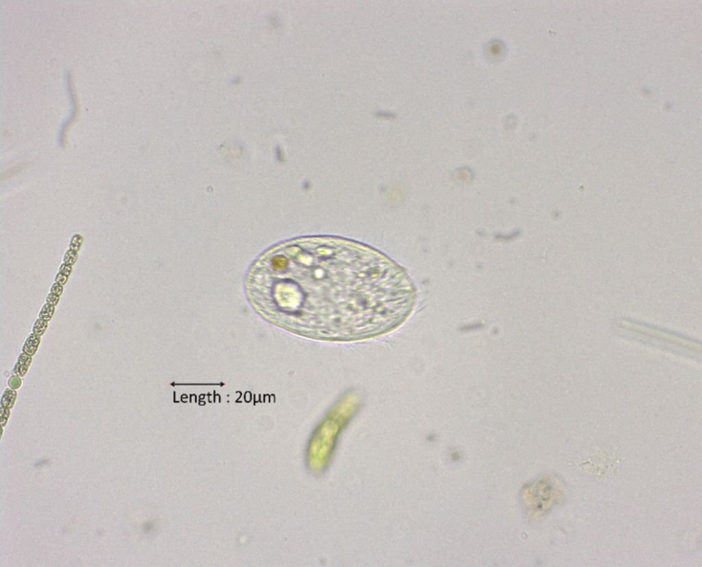 Glaucoma scintillans